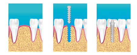 Implant dentaire à Boulogne